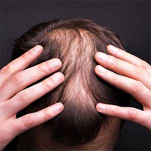 عملية زراعة الشعر